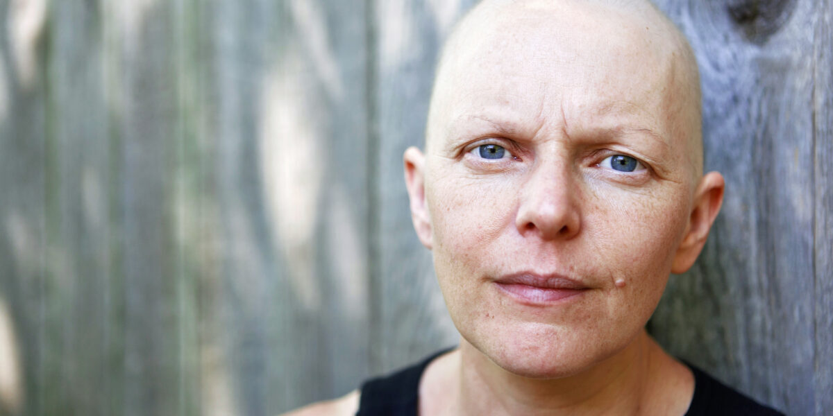 bald patient after chemotheropy treatment